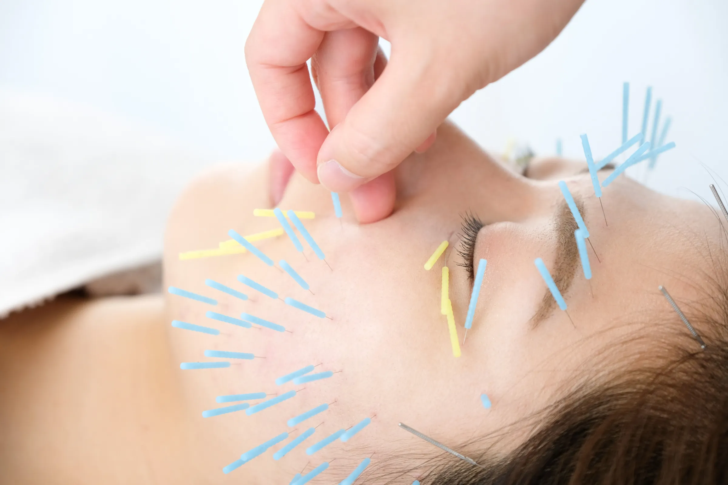 intro about acupunture